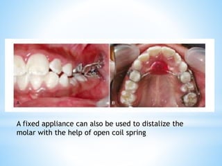 A fixed appliance can also be used to distalize the
molar with the help of open coil spring
 