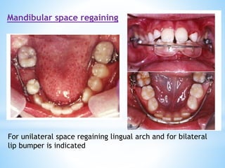 Mandibular space regaining
For unilateral space regaining lingual arch and for bilateral
lip bumper is indicated
 