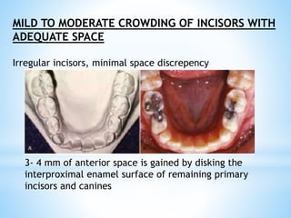 MILD TO MODERATE CROWDING OF INCISORS WITH
ADEQUATE SPACE
Irregular incisors, minimal space discrepency
3- 4 mm of anterior space is gained by disking the
interproximal enamel surface of remaining primary
incisors and canines
 