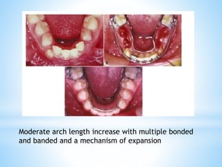 Moderate arch length increase with multiple bonded
and banded and a mechanism of expansion
 