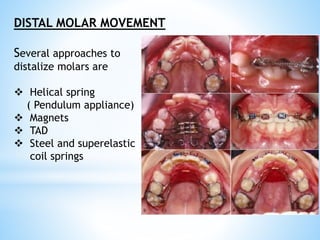 DISTAL MOLAR MOVEMENT
Several approaches to
distalize molars are
 Helical spring
( Pendulum appliance)
 Magnets
 TAD
 Steel and superelastic
coil springs
 