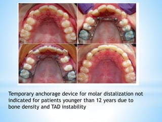Temporary anchorage device for molar distalization not
indicated for patients younger than 12 years due to
bone density and TAD instability
 