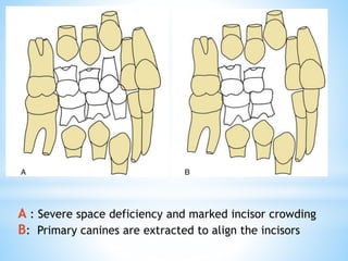 A : Severe space deficiency and marked incisor crowding
B: Primary canines are extracted to align the incisors
 