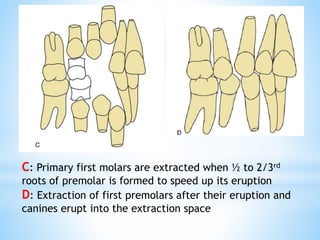 C: Primary first molars are extracted when ½ to 2/3rd
roots of premolar is formed to speed up its eruption
D: Extraction of first premolars after their eruption and
canines erupt into the extraction space
 
