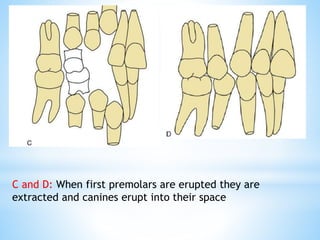 C and D: When first premolars are erupted they are
extracted and canines erupt into their space
 