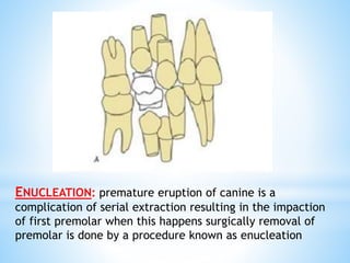 ENUCLEATION: premature eruption of canine is a
complication of serial extraction resulting in the impaction
of first premolar when this happens surgically removal of
premolar is done by a procedure known as enucleation
 