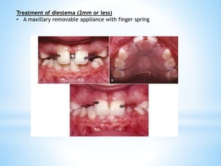 Treatment of diestema (2mm or less)
• A maxillary removable appliance with finger spring
 