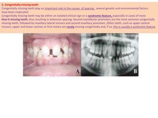 2. Congenitally missing teeth
Congenitally missing teeth play an important role in the causes of spacing , several genetic...