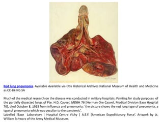 Red lung pneumonia. Available Available via Otis Historical Archives National Museum of Health and Medicine
as CC-BY-NC-SA

Much of the medical research on the disease was conducted in military hospitals. Painting for study purposes of
the partially dissected lungs of Pte. H.D. Cauvel, MDBH 76 [Herman Ore Cauvel, Medical Division Base Hospital
76], died October 8, 1918 from influenza and pneumonia: ‘the picture shows the red lung type of pneumonia, a
type of pneumonia which was peculiar to the pandemic’.
Labelled ‘Base Laboratory | Hospital Centre Vichy | A.E.F. [American Expeditionary Force’. Artwork by Lt.
William Schwarz of the Army Medical Museum.
 