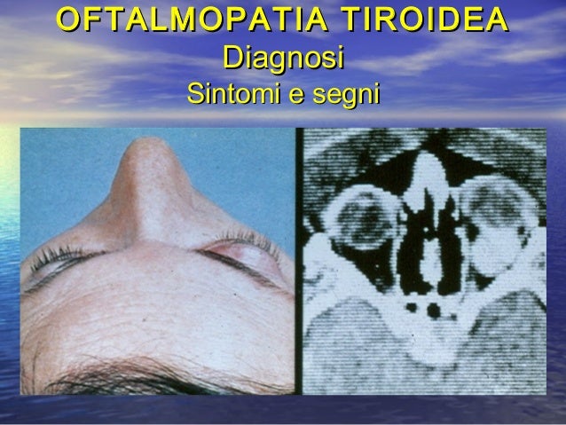 Edema A Mantellina E Esoftalmo