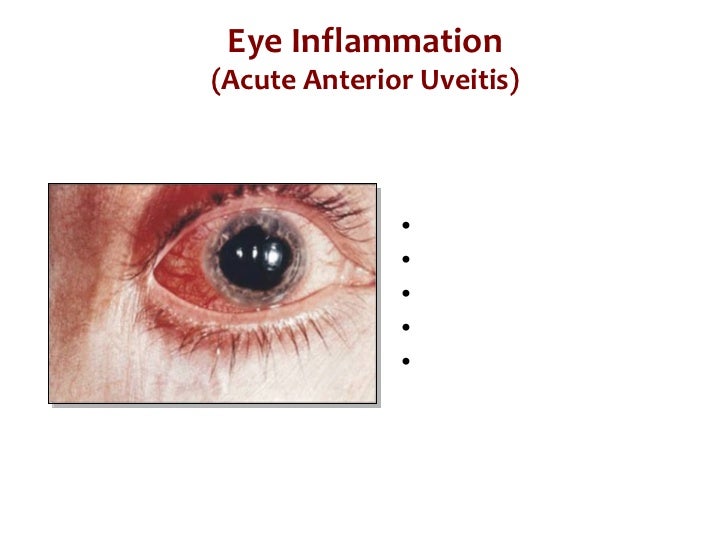 What is Spondyloarthritis? What is Psoriatic Arthritis?