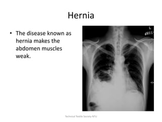 Hernia
• The disease known as
hernia makes the
abdomen muscles
weak.

Technical Textile Society-NTU

 