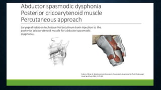 Spasmodic dysphonia | PPTX