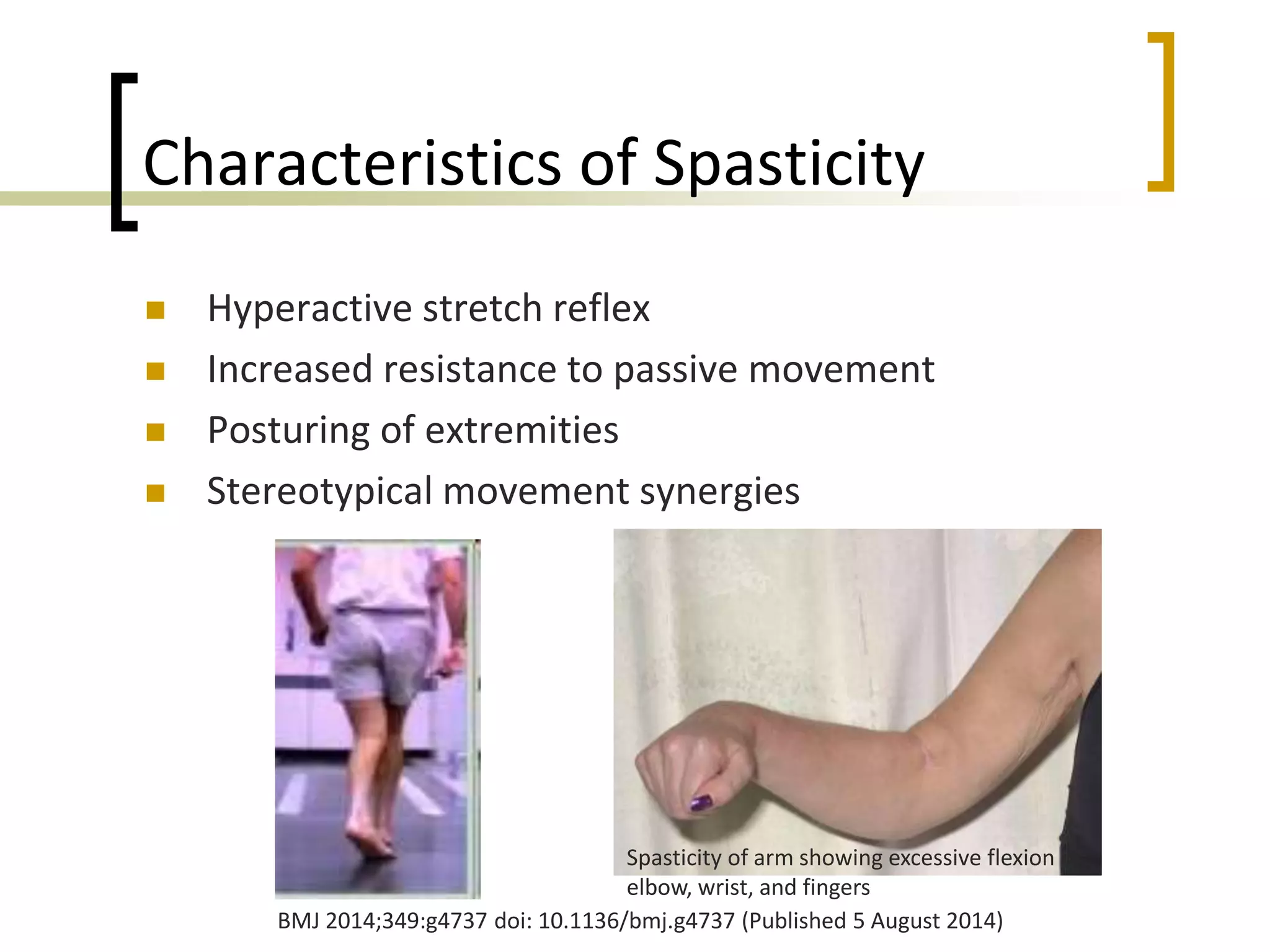 Characteristics of Spasticity
 Hyperactive stretch reflex
 Increased resistance to passive movement
 Posturing of extremities
 Stereotypical movement synergies
Spasticity of arm showing excessive flexion of
elbow, wrist, and fingers
BMJ 2014;349:g4737 doi: 10.1136/bmj.g4737 (Published 5 August 2014)
 