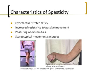 Characteristics of Spasticity
 Hyperactive stretch reflex
 Increased resistance to passive movement
 Posturing of extremities
 Stereotypical movement synergies
Spasticity of arm showing excessive flexion of
elbow, wrist, and fingers
BMJ 2014;349:g4737 doi: 10.1136/bmj.g4737 (Published 5 August 2014)
 