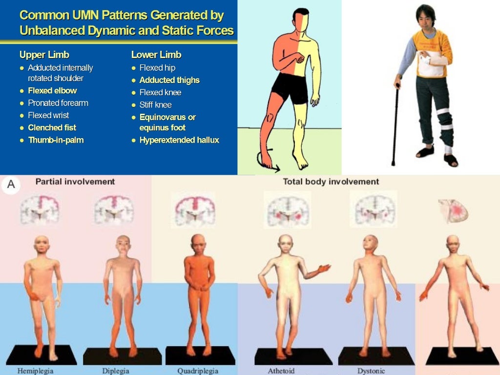 Spasticity in Rehabilitation