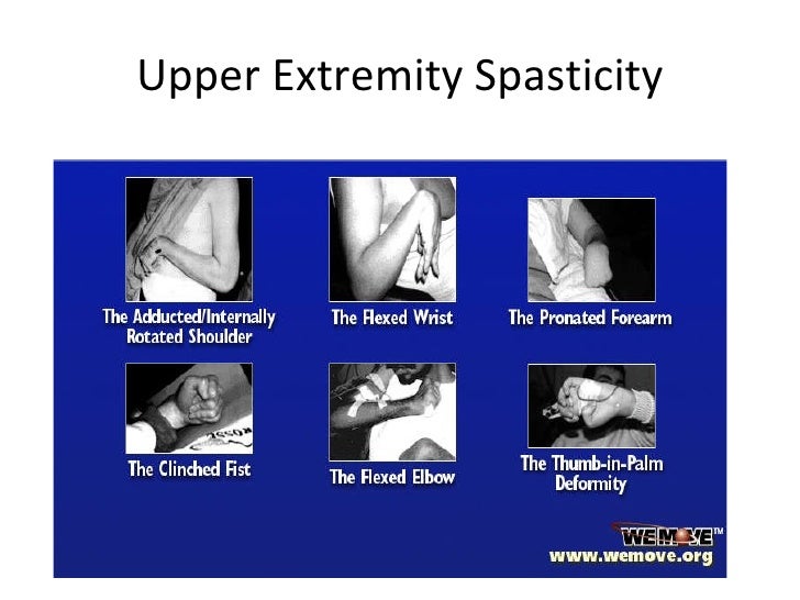 Upper Extremity Spasticity