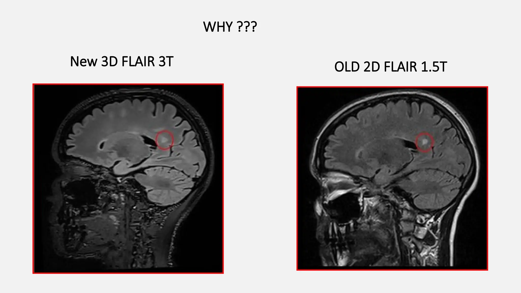 New 3D FLAIR 3T OLD 2D FLAIR 1.5T
WHY ???
 