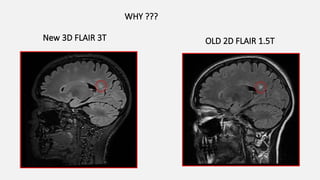 New 3D FLAIR 3T OLD 2D FLAIR 1.5T
WHY ???
 