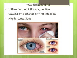 *CONJUNCTIVITIS
- Inflammation of the conjunctiva
- Caused by bacterial or viral infection
- Highly contagious
 