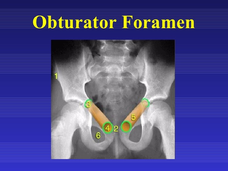 Special Consideration: The Obturator Hernia