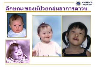ลักษณะของผูป่วยกลุมอาการดาวน์
           ้      ่
 
