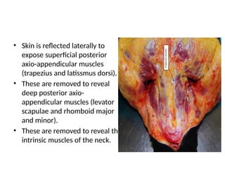 • Skin is reflected laterally to
expose superficial posterior
axio-appendicular muscles
(trapezius and latissmus dorsi).
• These are removed to reveal
deep posterior axio-
appendicular muscles (levator
scapulae and rhomboid major
and minor).
• These are removed to reveal the
intrinsic muscles of the neck.
 