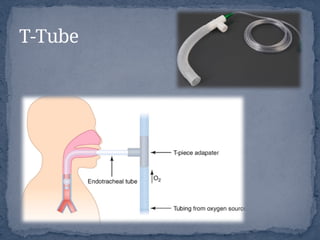 T-Tube
 