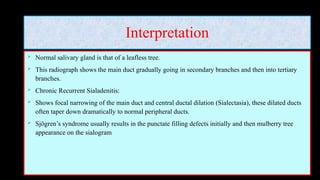 Interpretation
 Normal salivary gland is that of a leafless tree.
 This radiograph shows the main duct gradually going in secondary branches and then into tertiary
branches.
 Chronic Recurrent Sialadenitis:
 Shows focal narrowing of the main duct and central ductal dilation (Sialectasia), these dilated ducts
often taper down dramatically to normal peripheral ducts.
 Sjögren’s syndrome usually results in the punctate filling defects initially and then mulberry tree
appearance on the sialogram
 