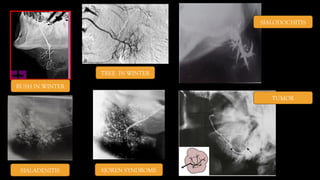 BUSH IN WINTER
TREE IN WINTER
SIALODOCHITIS
SIALADENITIS SJOREN SYNDROME
TUMOR
 