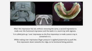 special impression procedures for tooth- tissue supported RPD.pptx