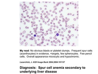 My read: No obvious blasts or platelet clumps. Frequent spur cells
(acanthocytes) in evidence, +targets, few spherocytes. Few pencil
cells. Overall appearance microcytic and hypochromic.
Lazarchick, J. ASH Image Bank 2004;2004:101137
Diagnosis: Spur cell anemia secondary to
underlying liver disease
 
