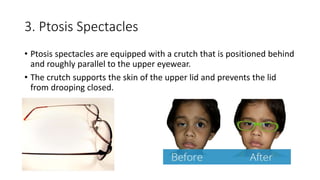 3. Ptosis Spectacles
• Ptosis spectacles are equipped with a crutch that is positioned behind
and roughly parallel to the upper eyewear.
• The crutch supports the skin of the upper lid and prevents the lid
from drooping closed.
 