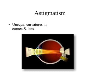 Astigmatism Unequal curvatures in cornea & lens 