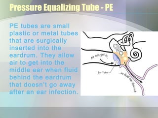 Pressure Equalizing Tube - PE
PE tubes are small
plastic or metal tubes
that are surgically
inserted into the
eardrum. They allow
air to get into the
middle ear when fluid
behind the eardrum
that doesn’t go away
after an ear infection .
 