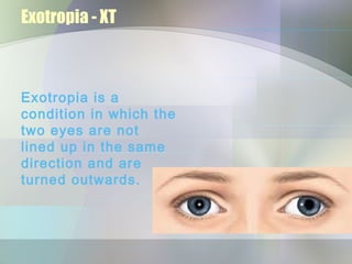 Exotropia - XT



Exotropia is a
condition in which the
two eyes are not
lined up in the same
direction and are
turned outwards.
 