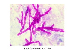 Candida seen on PAS stain
 