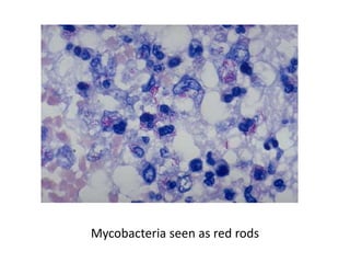 Mycobacteria seen as red rods
 