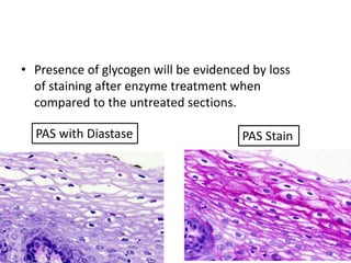 • Presence of glycogen will be evidenced by loss
of staining after enzyme treatment when
compared to the untreated sections.
PAS StainPAS with Diastase
 