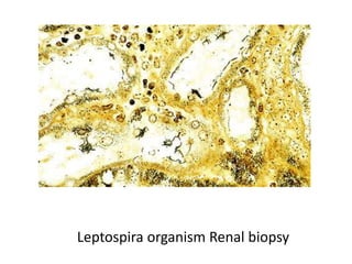 Leptospira organism Renal biopsy
 