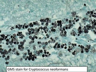GMS stain for Cryptococcus neoformans
 