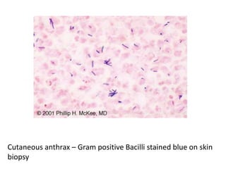 Cutaneous anthrax – Gram positive Bacilli stained blue on skin
biopsy
 