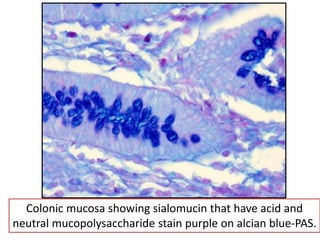 Colonic mucosa showing sialomucin that have acid and
neutral mucopolysaccharide stain purple on alcian blue-PAS.
 