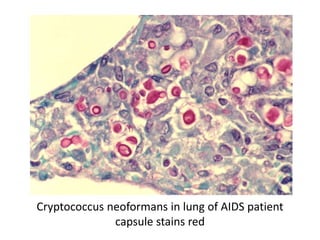 Cryptococcus neoformans in lung of AIDS patient
capsule stains red
 