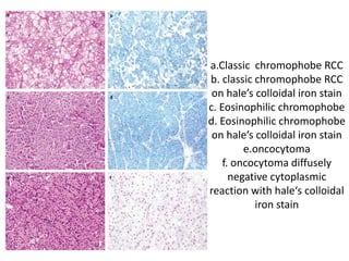 a.Classic chromophobe RCC
b. classic chromophobe RCC
on hale’s colloidal iron stain
c. Eosinophilic chromophobe
d. Eosinophilic chromophobe
on hale’s colloidal iron stain
e.oncocytoma
f. oncocytoma diffusely
negative cytoplasmic
reaction with hale‘s colloidal
iron stain
 