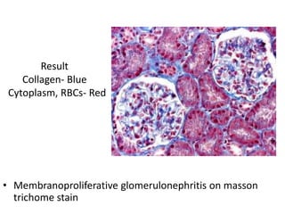 Result
Collagen- Blue
Cytoplasm, RBCs- Red
• Membranoproliferative glomerulonephritis on masson
trichome stain
 
