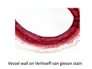 Vessel wall on Verhoeff van gieson stain
 