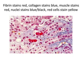 Fibrin stains red, collagen stains blue, muscle stains
red, nuclei stains blue/black, red cells stain yellow
 