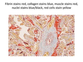 Fibrin stains red, collagen stains blue, muscle stains red,
nuclei stains blue/black, red cells stain yellow
 