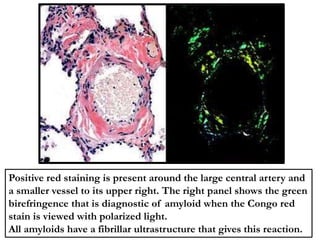 Positive red staining is present around the large central artery and
a smaller vessel to its upper right. The right panel shows the green
birefringence that is diagnostic of amyloid when the Congo red
stain is viewed with polarized light.
All amyloids have a fibrillar ultrastructure that gives this reaction.
 